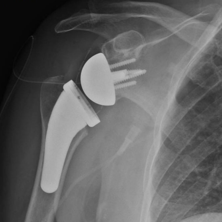 Shoulder Replacement – Patient Story